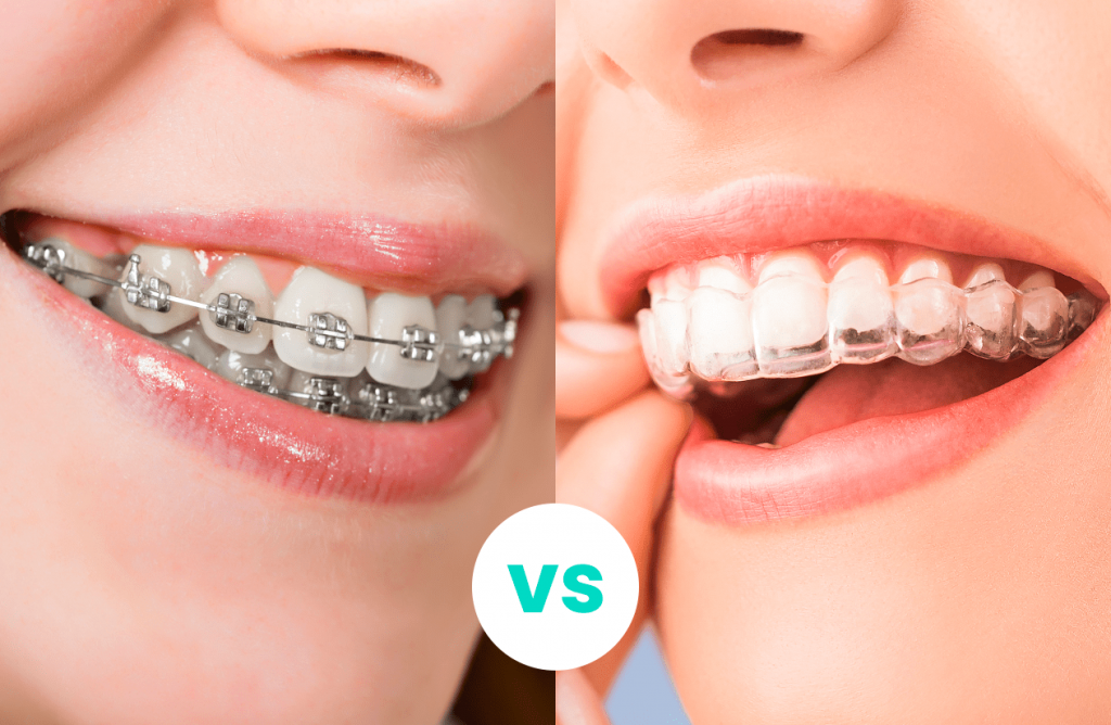 Clearfy Florida Blog Aligners